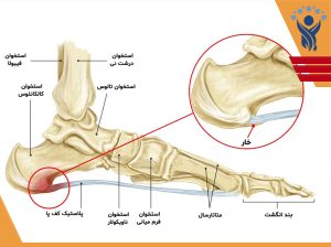 خار پاشنه و درمان آن/ فیزیوتراپی در شرق تهران