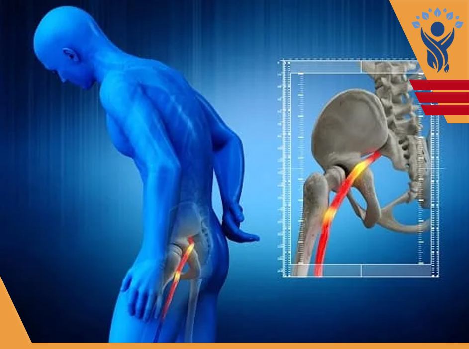 درمان درد عصب سیاتیک / فیزیوتراپی در شرق تهران