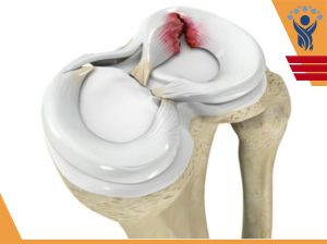 منیسک و درمان آن/ فیزیوتراپی در شرق تهران