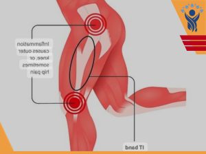 سندرم ایلیوتیبیال باند چیست؟ /فیزیوتراپی در شرق تهران