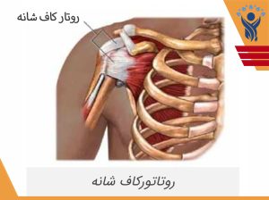 تاندونیت و پارگی روتاتور کاف شانه /فیزیوتراپی در شرق تهران