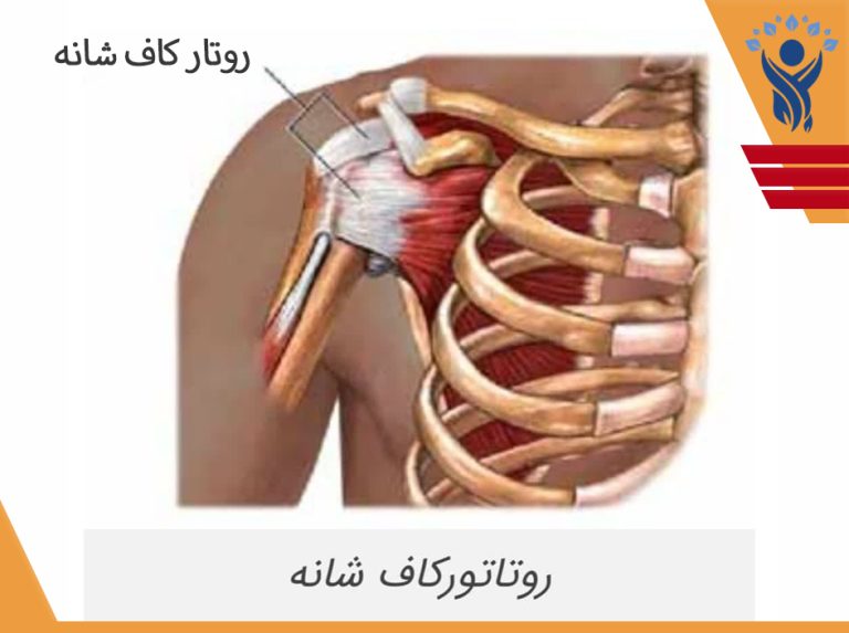 تاندونیت و پارگی روتاتور کاف شانه /فیزیوتراپی در شرق تهران