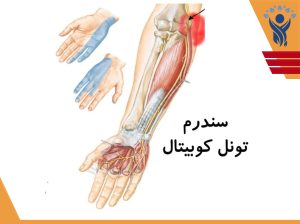 سندرم تونل کوبیتال /فیزیوتراپی در شرق تهران