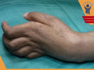 کنتراکچر ولکمن /فیزیوتراپی در شرق تهران