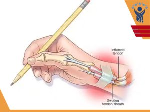 سندرم دکوروان /فیزیوتراپی در شرق تهران