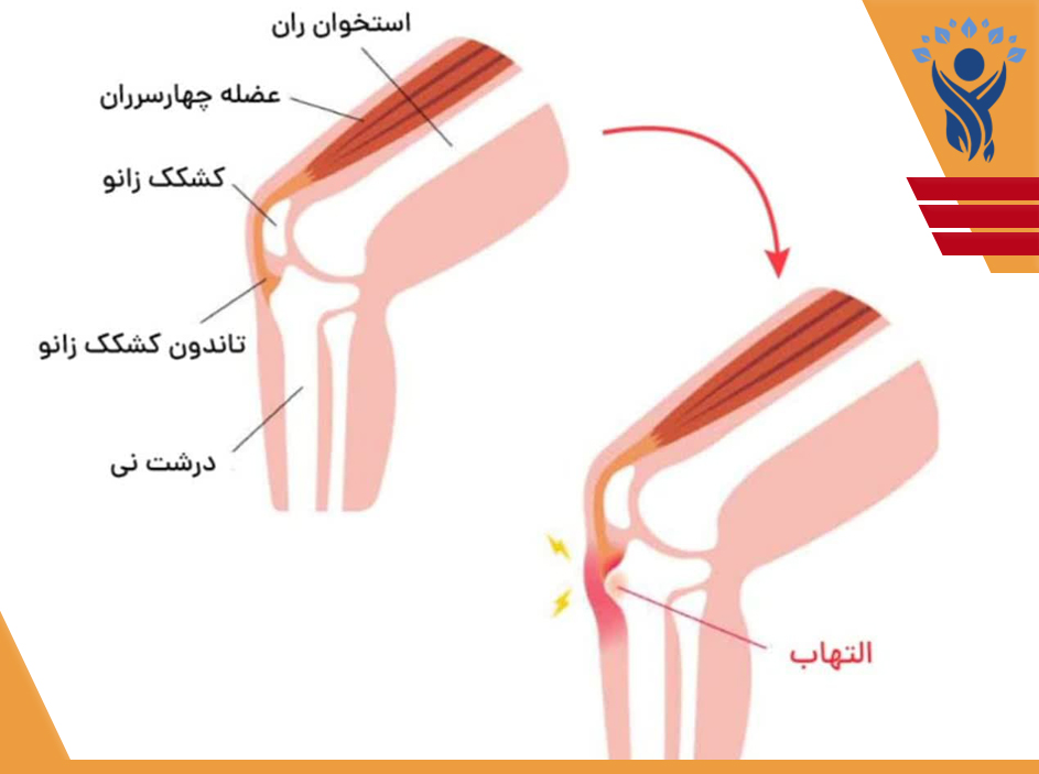ازگود اشلاتر / فیزیوتراپی در شرق تهران