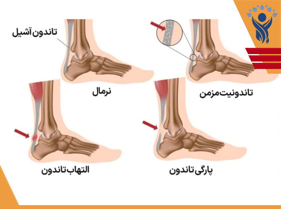 تاندونیت آشیل / فیزیوتراپی در شرق تهران