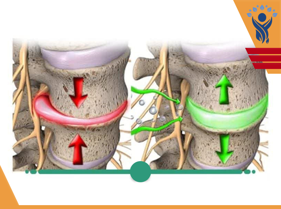 دیسک بین مهره ای(قسمت دوم)/فیزیوتراپی در تهرانپارس