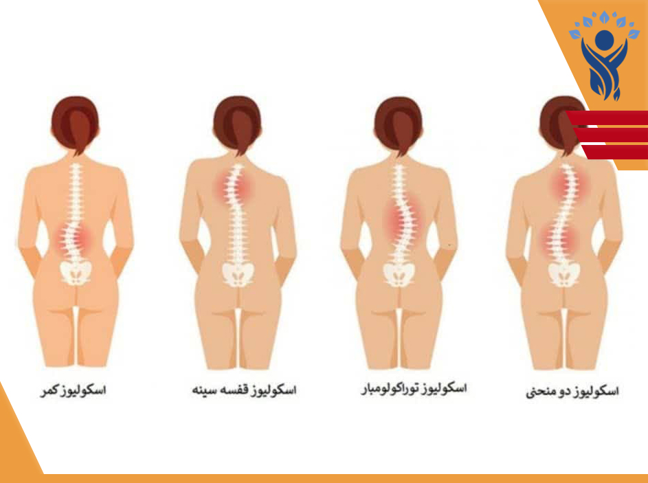 انحراف ستون فقرات یا اسکولیوز /فیزیوتراپی در تهرانپارس