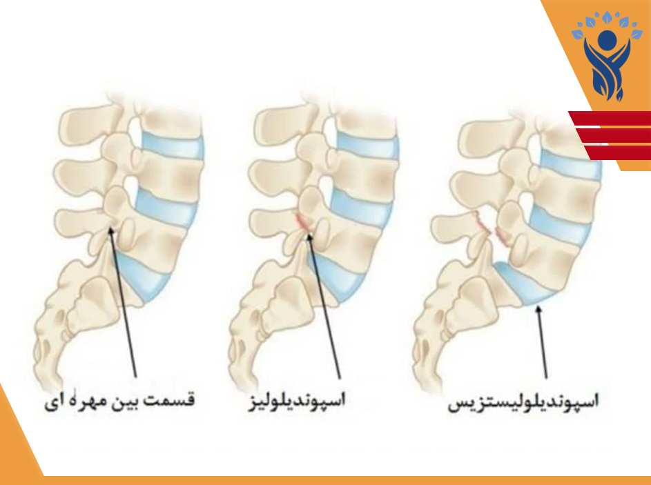 سرخوردگی مهره /فیزیوتراپی در تهرانپارس
