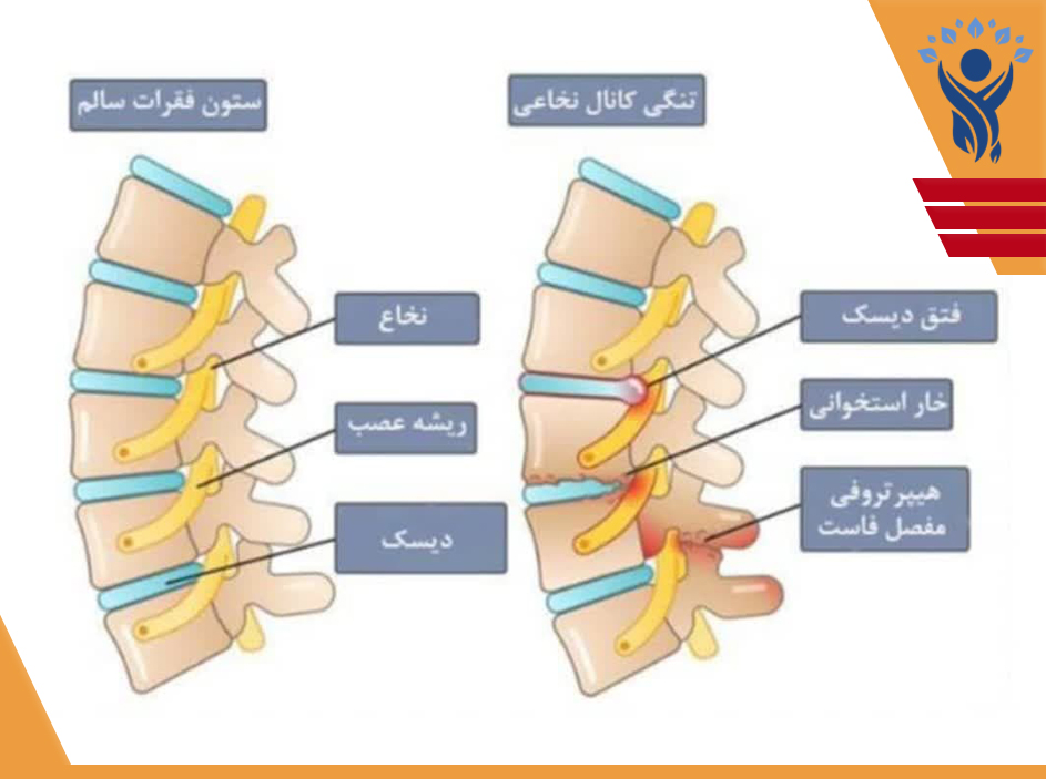 سندرم فاست ( Facet Syndrome )/فیززیوتراپی در تهرانپارس
