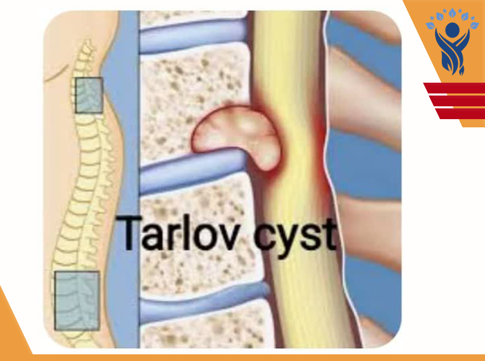 کسیت تارلوف (Tarlov Cyst )/فیزیوتراپی در شرق تهران کسیت تارلوف (Tarlov Cyst )،کیست ها حفره هایی هستند متشکل از یک لایه غشایی که درون آنها از موادی مانند خون، مایع مغزی نخاعی، ترشحات عفونی و غیره پر شده است. کیست به تنهایی و بطور معمول برای بدن مشکلی ایجاد نمیکند اما بسته به محل قرارگیری و اندازه آن ممکن است باعث ایجاد علائم متفاوتی شود. کیستهای ستون فقرات از نوع کیستهایی هستند که بدلیل بروز در کانال نخاعی و ایجاد تنگی در کانال و یا فشار روی ریشه عصبی اغلب با درد همراهند. کیست تارلوف یکی از انواع کیستهای ستون فقرات است که در انتهای کمر و ناحیه ساکرال ایجاد میشود و خصوصیت متفاوت آن از کیستهای دیگر ستون فقرات وجود رشته هایی از ریشه عصب نخاعی در خود کیست یا دیواره آن است. محتوای کیست تارلوف نیز مایع مغزی نخاعی است. علت: با اینکه کیست تارلوف اولین بار در سال ۱۹۳۸ کشف شد اما در مورد آن اطلاعات دقیقی وجود نداشته و علت خاصی برای آن ذکر نشده است. شیوع این کیست حدود ۸ درصد و بدون علت است و افراد مبتلا بصورت اتفاقی در جریان تشخیص مشکلات دیگر متوجه آن میشوند. طبق آمار بیشتر در سنین ۳۰ تا ۶۰ سال و در زنان بیشتر از مردان دیده میشود. علائم: کیست تارلوف معمولا بدون علامت است و از آنجائیکه در ناحیه انتهای ستون فقرات ایجاد میشود ، در صورتیکه تحت فشار قرار گیرد و یا باعث فشار روی نخاع و ریشه های عصبی شود، بصورت کمردرد خود را نشان میدهد و به همین علت با اختلالات دیگری مثل دیسک کمر یا بیماریهای مربوط به زنان اشتباه گرفته میشود. علائم بالینی بطور معمول عبارتند از: • درد در حالت نشستن، ایستادن و راه رفتن و تسکین درد فقط در حالت خوابیده • درد در ناحیه وجود کیست ( اغلب باسن ) • عدم توانایی نشستن طولانی مدت • در صورت فشار بر روی اعصاب از دست دادن حس لامسه و ضعیف شدن عضلات • اختلال در دستگاه گوارش و عملکرد روده • اختلال در عملکرد مثانه و بی اختیاری و تکرر ادرار • اختلال در عملکرد جنسی تشخیص: همانطور که گفته شد کیست تارلوف علامتی ندارد و زمانی به وجود آن پی برده میشود که شخص بدلیل مشکلات دیگر ستون فقرات برای درمان مراجعه میکند و به این ترتیب در تصویر برداریهای پزشکی به وجود آن پی برده میشود. درمان: برای درمان علائم ناشی از کیست تارلوف در وهله اول از روشهای غیر جراحی مانند دارودرمانی، تزریق استروئید در فضای اپیدورال و فیزیوتراپی استفاده میشود. روش جراحی برای بیمارانی توصیه میشود که کیست آنها قطر بیشتر از ۱/۵ سانتیمتر داشته و از دردهای رادیکولر شدید و اختلال عملکرد روده و مثانه رنج میبرند.
