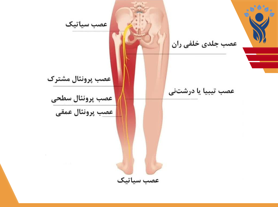 سیاتیک (Sciatic)/فیزیوتراپی در تهرانپارس
