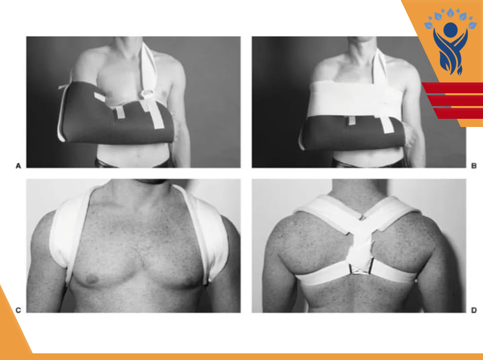 شکستگی ترقوه (Clavicle Fracture)/فیزیوتراپی در تهران پارس