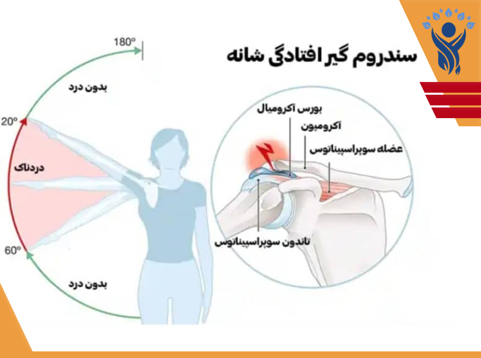 سندرم گیرافتادگی شانه /فیزیوتراپی در تهران پارس