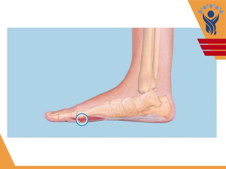 سزاموئیدیت(Sesamoiditis) /فیزیوتراپی در فلکه سم تهرانپارس