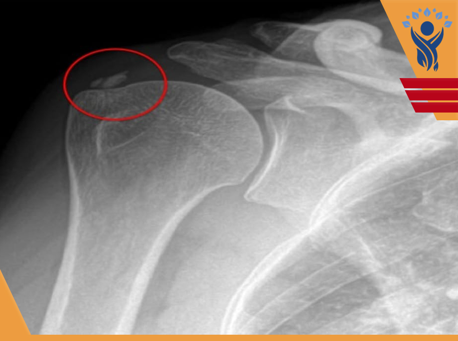 کلسیفیکاسیون(Calcification)/فیزیوتراپی در شرق تهران