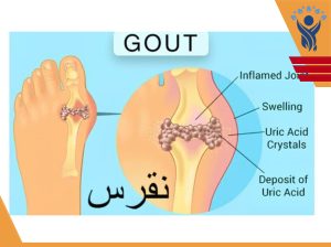 نقرس /فیزیوتراپی در فلکه سوم تهرانپارس