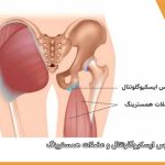 درد نشیمنگاه /فیزیوتراپی در فلکه سوم تهرانپارس