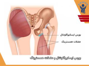 درد نشیمنگاه /فیزیوتراپی در فلکه سوم تهرانپارس