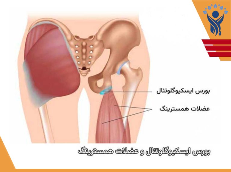 درد نشیمنگاه /فیزیوتراپی در فلکه سوم تهرانپارس