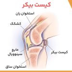 کیست بیکر (Baker's Cyst) / فیزیوتراپی در فلکه سوم تهرانپارس