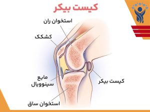 کیست بیکر (Baker's Cyst) / فیزیوتراپی در فلکه سوم تهرانپارس