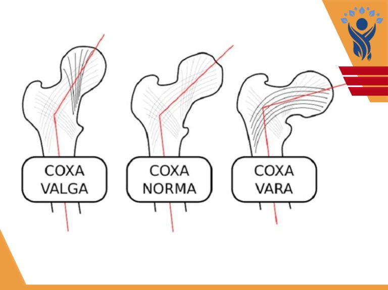 کوکسا والگا‌(Coxa Valga) /فیزیوتراپی در فلکه سوم تهرانپارس