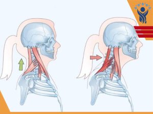 قوز گردن (Neck Hump)/فیزیوتراپی در فلکه سوم تهرانپارس